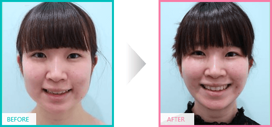 before after